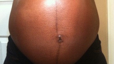 linea-nigra-in-pregnancy